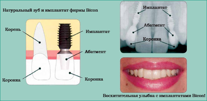 Натуральный зуб и имплантат фирмы Bicon