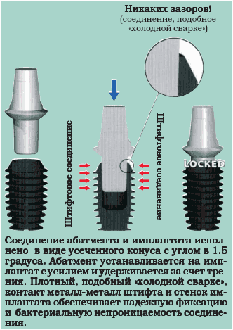 Соединение абатмента и имплантата