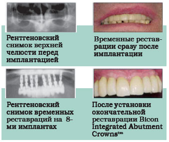Немедленная функциональная нагрузка