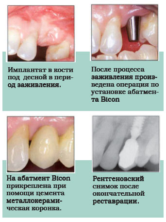 Двухстадийная хирургическая техника